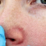 Как избавиться от чёрных точек и сужать поры