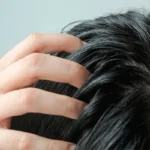 Правильный уход за жирной кожей головы